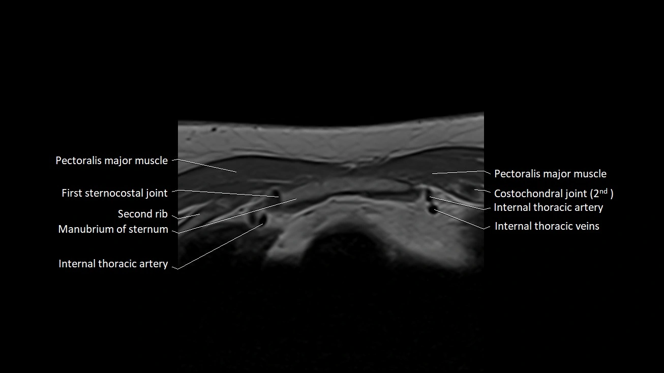 MRI sternum and sternoclavicular joint labeled axial anatomy image 10.webp